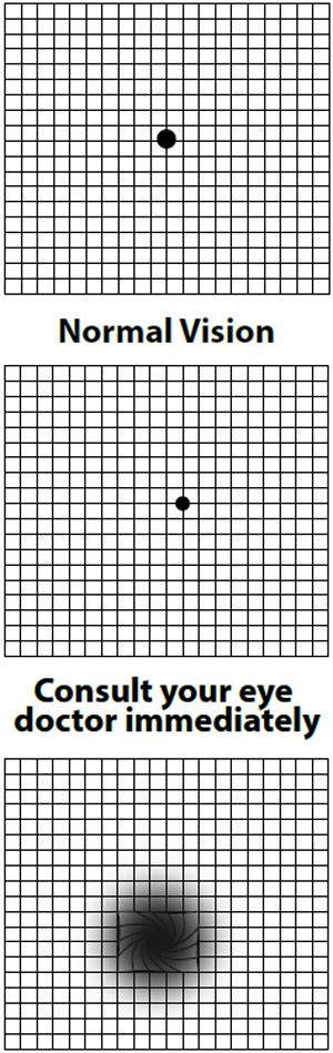 amsler grid interpretation|amsler grid eye chart.